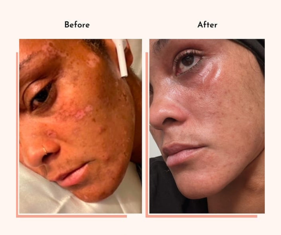 Hyperpigmentation Fix supplement