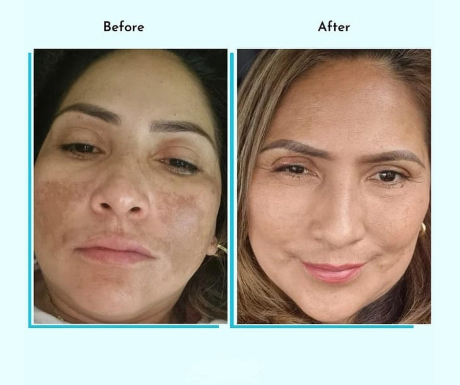 Hyperpigmentation Fix supplement