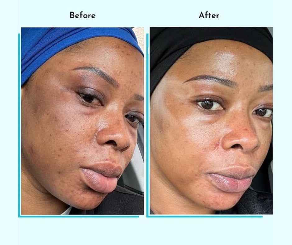 Hyperpigmentation Fix supplement