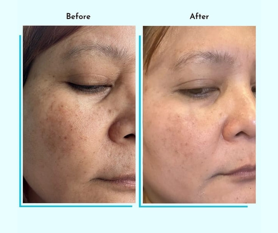 Hyperpigmentation Fix supplement