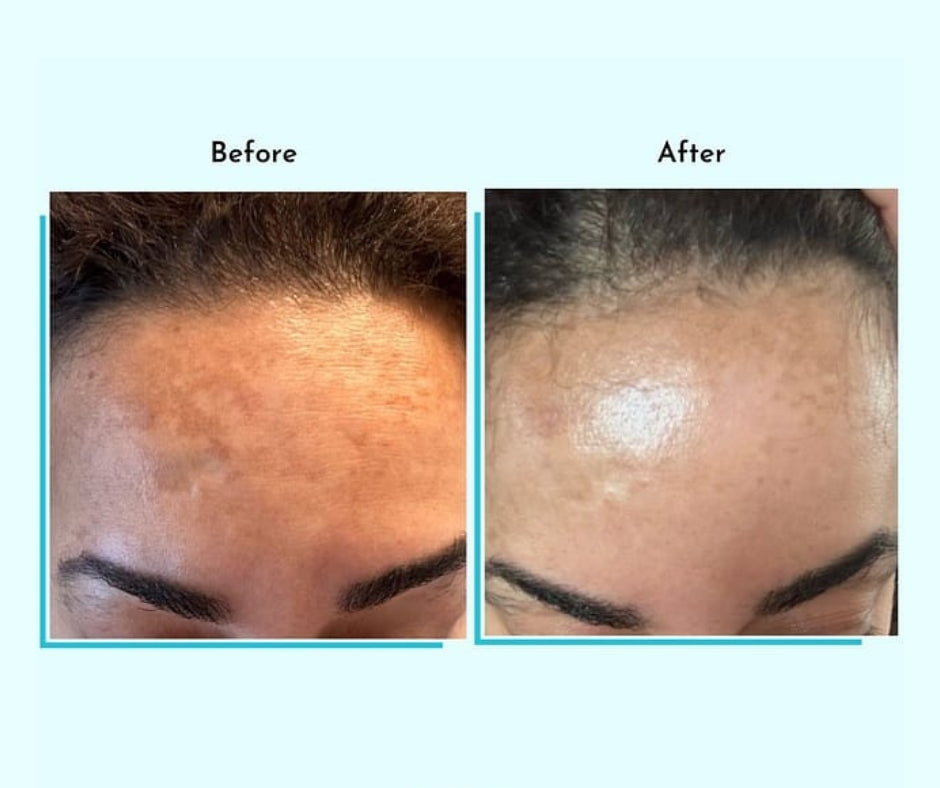 Hyperpigmentation Fix supplement