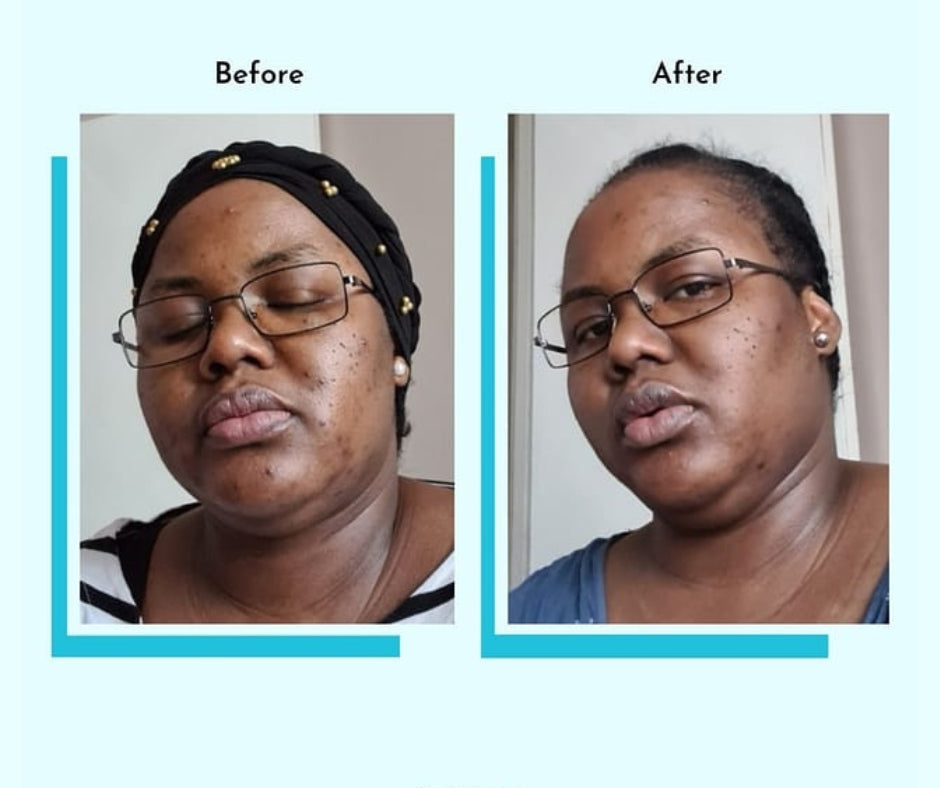 Hyperpigmentation Fix supplement