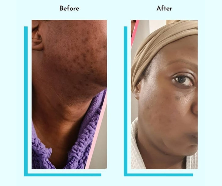 Hyperpigmentation Fix supplement