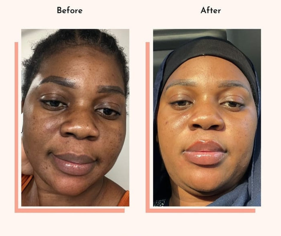 Hyperpigmentation Fix supplement