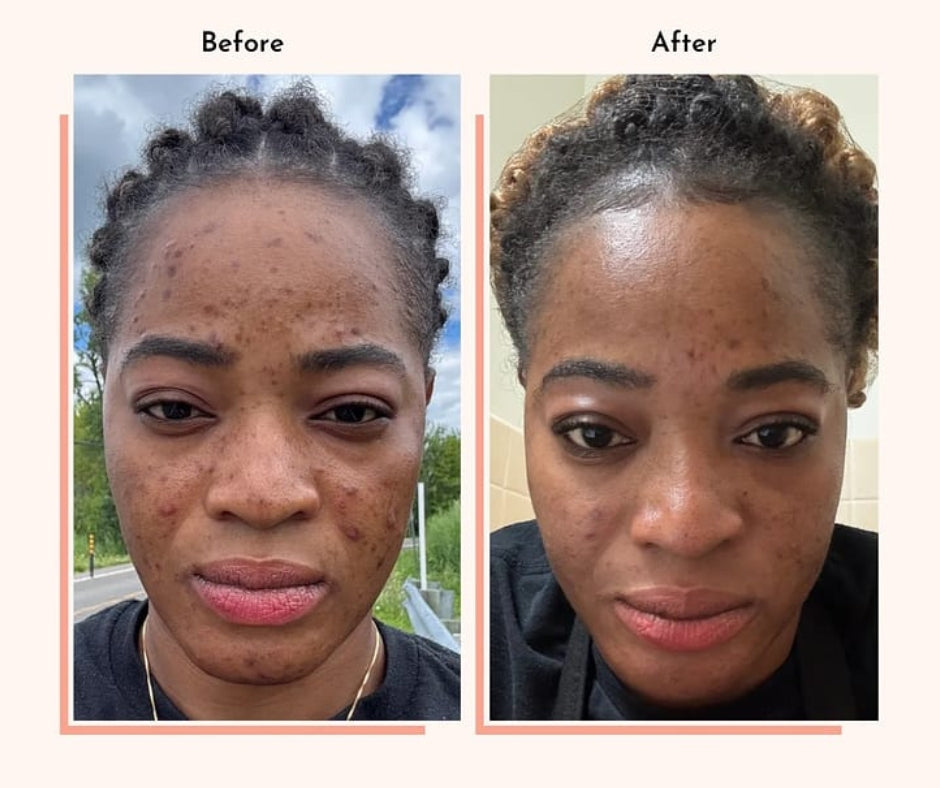 Hyperpigmentation Fix supplement