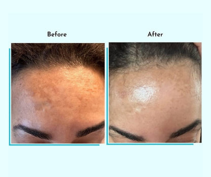 Hyperpigmentation Fix supplement