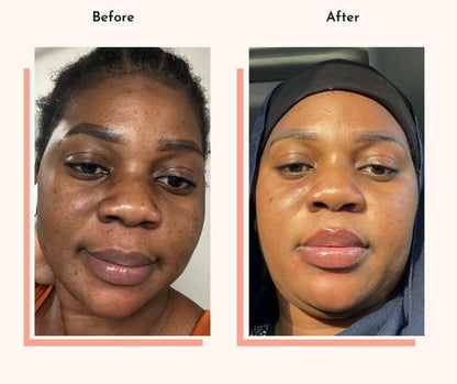 Hyperpigmentation Fix supplement